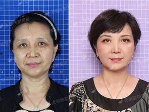 明星打botox,揭秘美容界的秘密武器